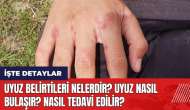 Uyuz belirtileri nelerdir? Uyuz nasıl bulaşır? Nasıl tedavi edilir?