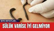 Sülük varise iyi gelmiyor