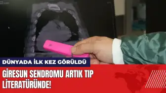 Dünyada ilk kez görüldü: Giresun Sendromu tıp literatüründe!