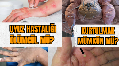 Uyuz hastalığı ölümcül mü? Kurtulmak mümkün mü?