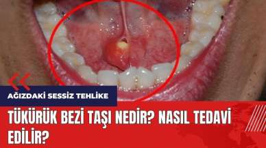 Ağızdaki sessiz tehlike! Tükürük bezi taşı nasıl tedavi edilir?