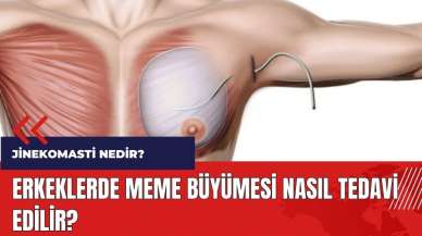 Erkeklerde meme büyümesi nasıl tedavi edilir? Jinekomasti nedir?