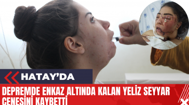 Hatay'da Depremde Enkaz Altında Kalan Yeliz Seyyar Çenesini Kaybetti