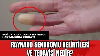 Soğuk havalarda Raynaud hastalığına dikkat! Raynaud sendromu belirtileri ve tedavisi nedir?