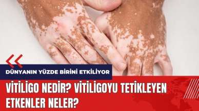 Vitiligo nedir? Vitiligoyu tetikleyen etkenler neler?