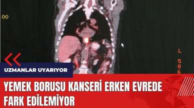 Yemek Borusu Kanseri erken evrede fark edilemiyor