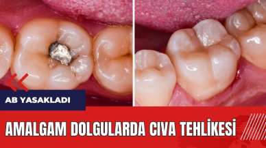 Amalgam dolgularda cıva tehlikesi