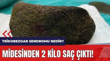 Midesinden 2 kilo saç çıktı! Trikobezoar sendromu nedir?