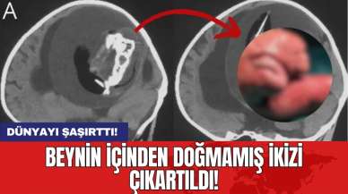 Dünyayı şaşırttı! Beynin içinden doğmamış ikizi çıkartıldı!