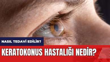 Keratokonus hastalığı nedir? Nasıl tedavi edilir?