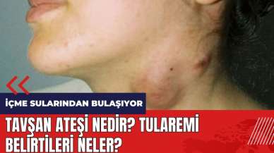 Tavşan ateşi nedir? Tularemi belirtileri neler?