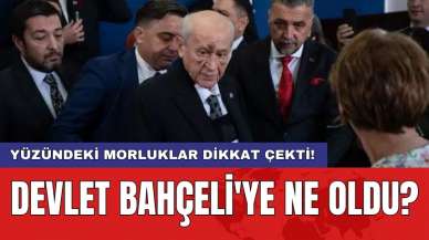 Yüzündeki morluklar dikkat çekti! Devlet Bahçeli'ye ne oldu?