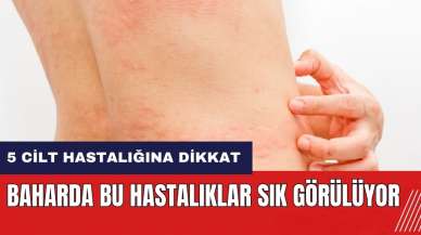 5 cilt hastalığına dikkat! Baharda bu hastalıklar sık görülüyor