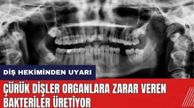 Diş hekiminden uyarı: Çürük dişler organlara zarar veren bakteriler üretiyor