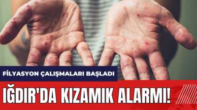 Iğdır'da kızamık alarmı! Filyasyon çalışmaları başladı