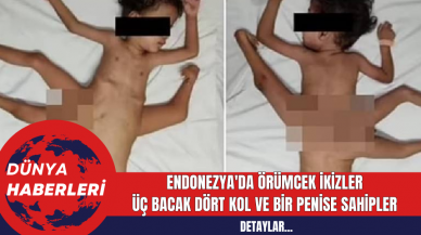 Endonezya'da Örümcek İkizler: Üç Bacak Dört Kol ve Bir Penise Sahipler