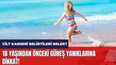 18 yaşından önceki güneş yanıklarına dikkat! Cilt kanseri belirtileri neler?