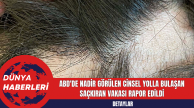 ABD'de Nadir Görülen Cinsel Yolla Bulaşan Saçkıran Vakası Rapor Edildi