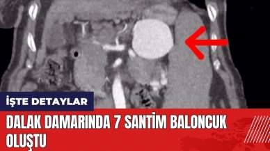 Dalak damarında 7 santim baloncuk oluştu