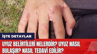 Uyuz belirtileri nelerdir? Uyuz nasıl bulaşır? Nasıl tedavi edilir?