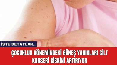 Çocukluk Dönemindeki Güneş Yanıkları Cilt Kanseri Riskini Artırıyor