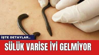 Sülük varise iyi gelmiyor