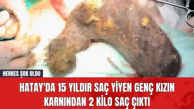 Hatay'da 15 Yıldır Saç Yiyen Genç Kızın Karnından 2 Kilo Saç Çıktı