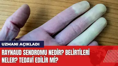 Raynaud Sendromu Nedir? Belirtileir neler? Tedavi edilir mi?