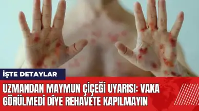 Maymun çiçeği uyarısı: Vaka görülmedi diye rehavete kapılmayın