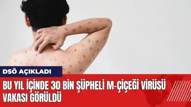 DSÖ: Bu yıl içinde 30 bin şüpheli M-çiçeği virüsü vakası görüldü