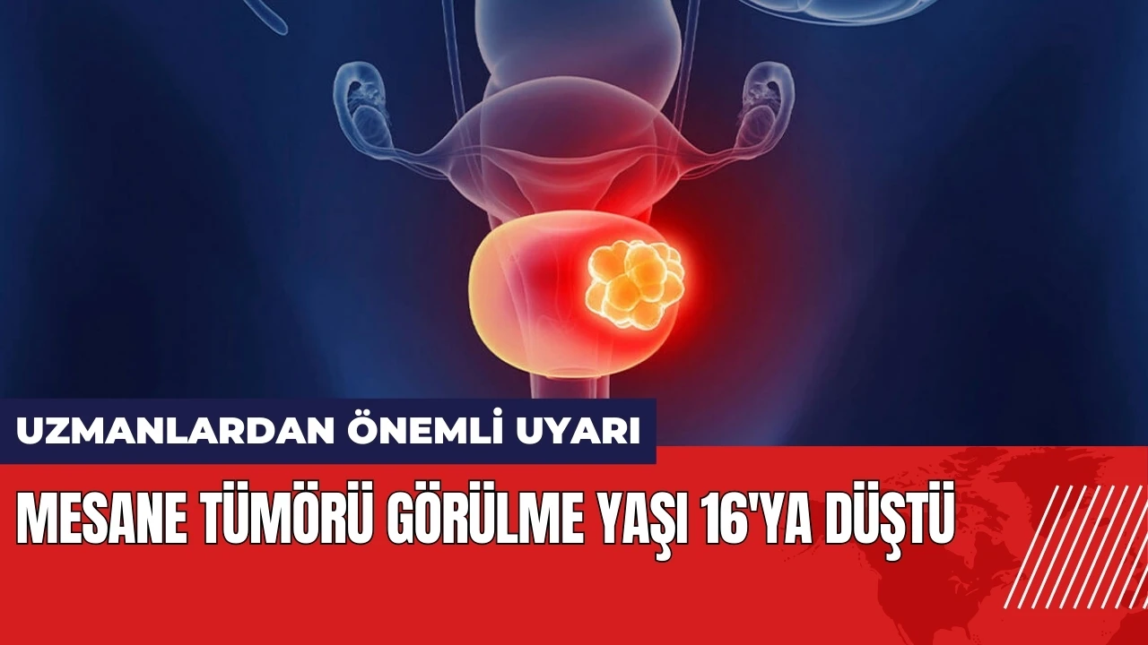 Mesane tümörü görülme yaşı 16'ya düştü