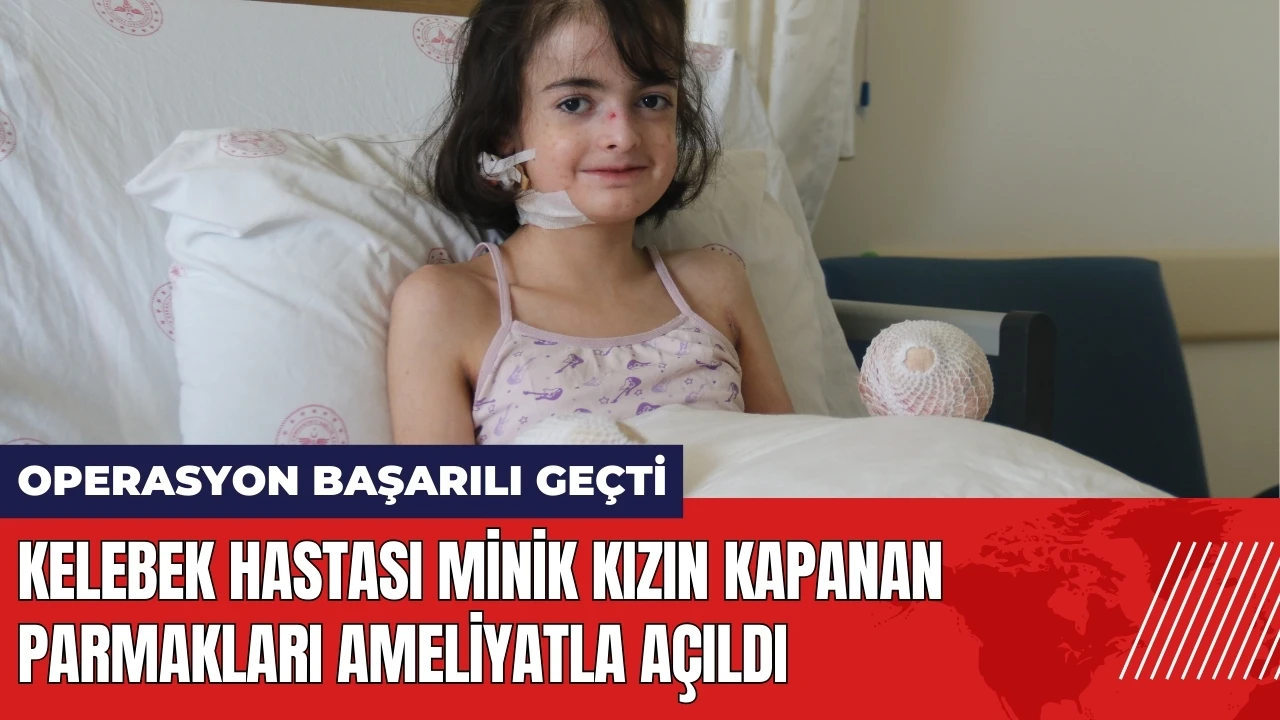 Kelebek hastası minik kızın kapanan parmakları ameliyatla açıldı