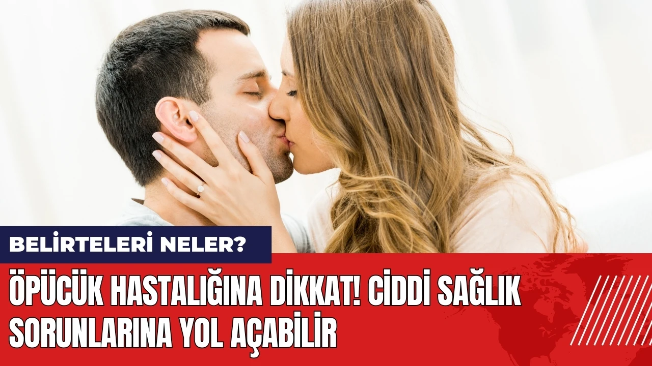 Öpücük hastalığına dikkat! Ciddi sağlık sorunlarına yol açabilir