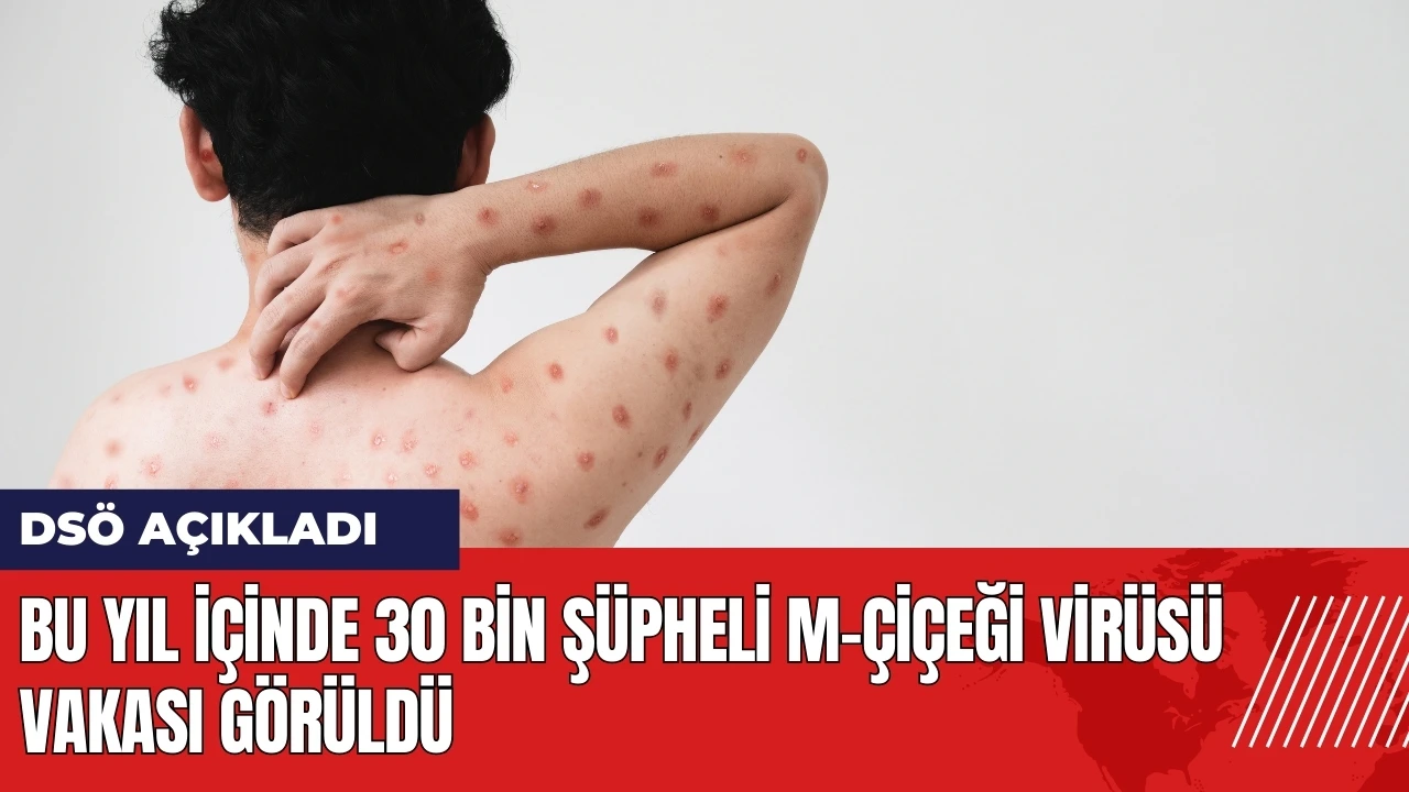 DSÖ: Bu yıl içinde 30 bin şüpheli M-çiçeği virüsü vakası görüldü